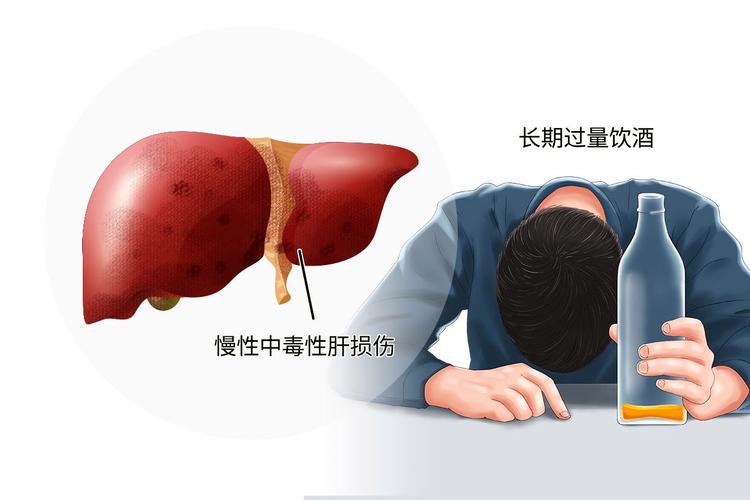 酒料-酒精肝症状表现有哪些症状