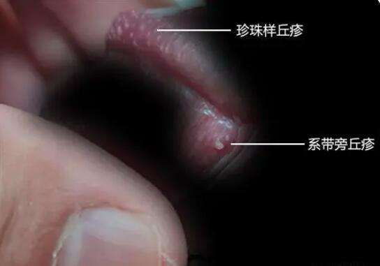 珍珠-珍珠疹怎么去除小妙招